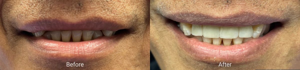 hillsboro-dental-before-after-1