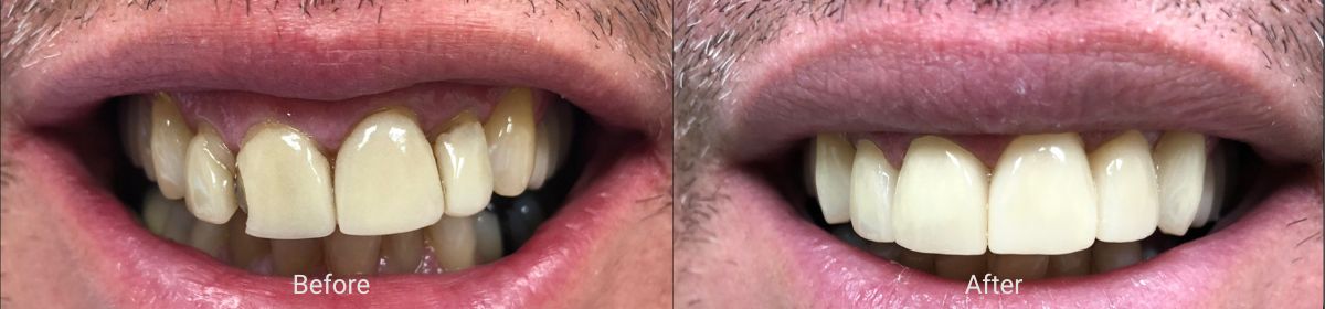 hillsboro-dental-before-after-2